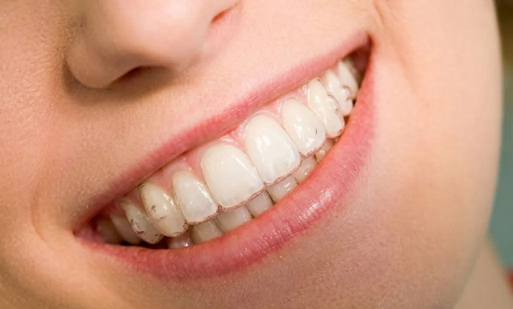 Patient smiling with ClearSet clear aligners